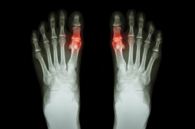Definition and Risk Factors of Gout