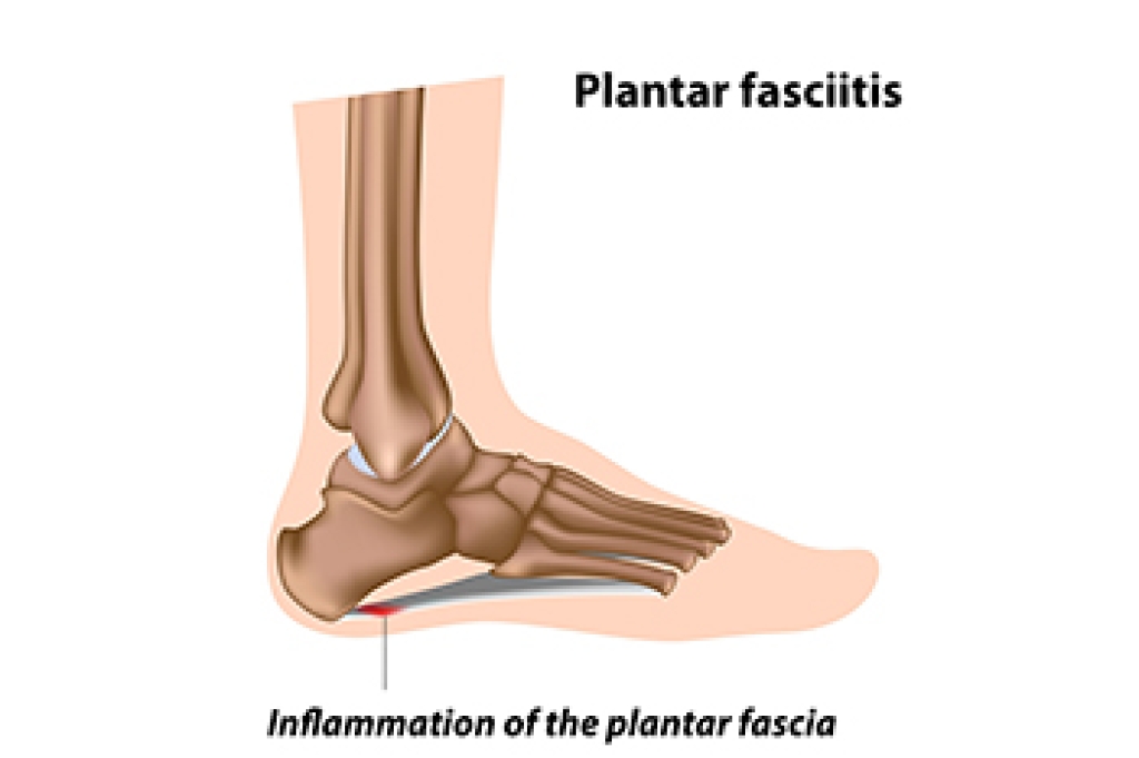 Heel Pain May Indicate Plantar Fasciitis