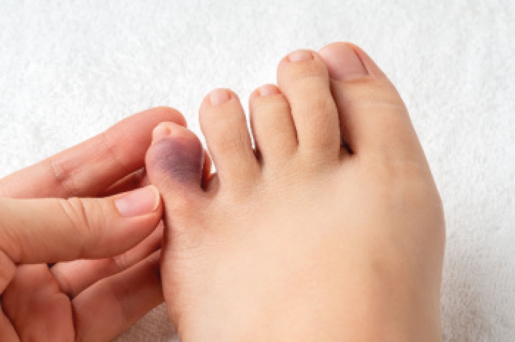 Understanding Pinky Toe Pain
