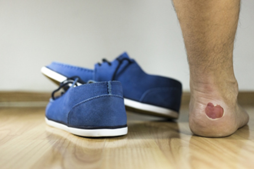 How Shoes Can Cause Foot Blisters