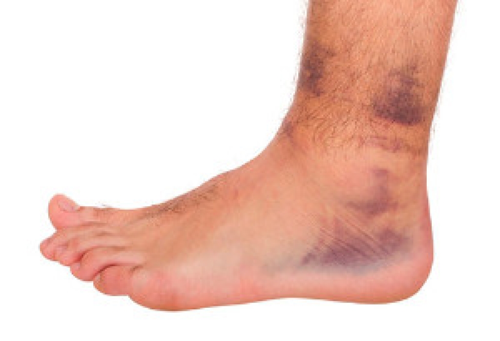 Ways Ankle Sprains and Fractures Are Different