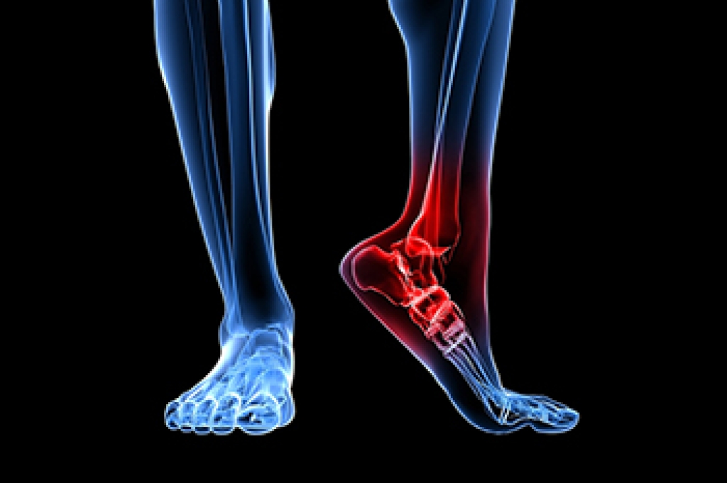 Heel Pain and Stress Fractures