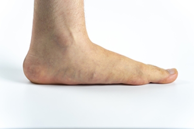 How a Podiatrist Can Help People With Flat Feet
