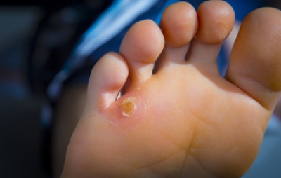 Corns on the Feet Are Small Bumps That Can Cause Big Discomfort