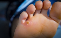 Corns on the Feet Are Small Bumps That Can Cause Big Discomfort