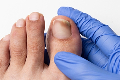 Toenail Fungus and When to Seek Podiatric Care