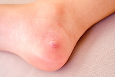 The Trouble with Blisters