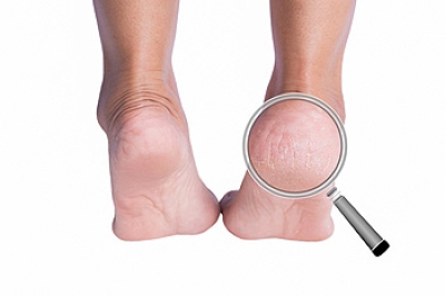 Why Do I Have Cracked Heels?