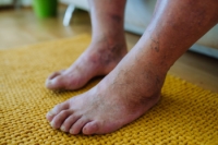 How Diabetes Can Affect Feet