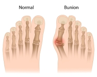 Why Women Are More Prone to Bunions