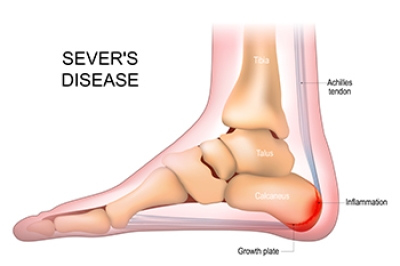 Sever’s Disease in Growing Children