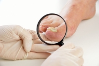 How Do You Get Toenail Fungus?